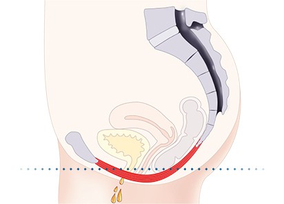 Pelvic-Floor Muscle Repair 5 Pelvic floor muscles Poole