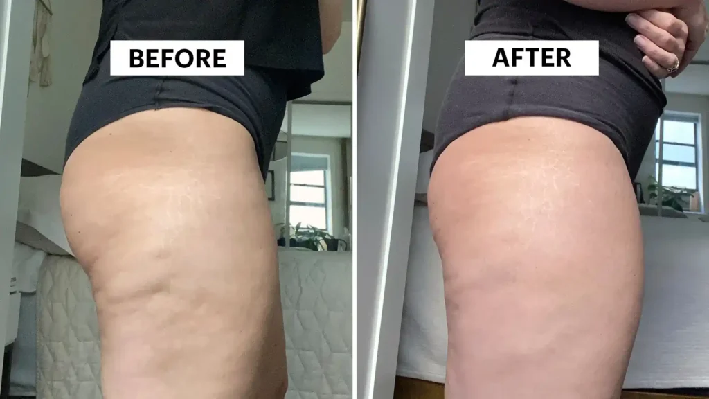 Sculpting Your Bum: Can Toning Exercises Really Reduce Cellulite? 1 Do Toning Exercise Poole Really Tackle Cellulite?