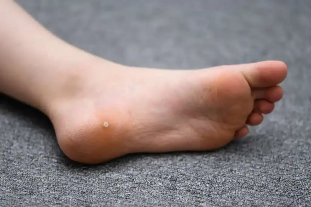 Cryotherapy For Warts And Also Verrucas 2 Image of verruca on the bottom of the foot that able to be treated with Cryotherapy Poole