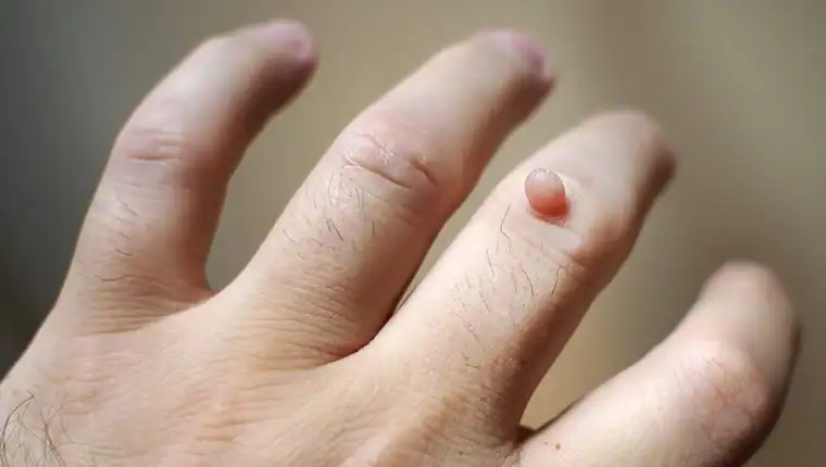 Cryotherapy For Warts And Also Verrucas 1 Image of blemish that Cryotherapy Poole can remove with Lipo 360.