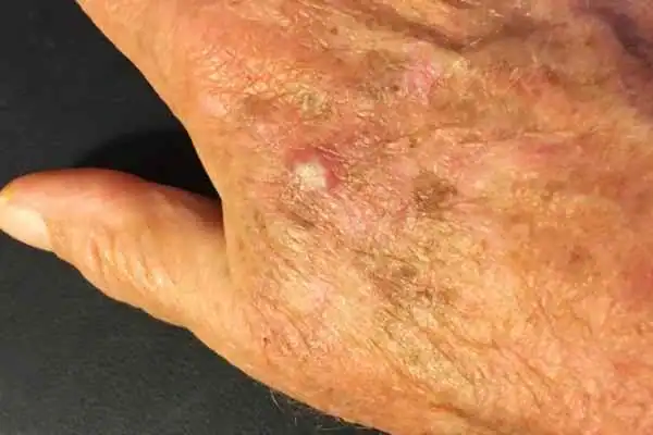 Cryopen For Actinic Keratoses 1 Image of Actinic keratoses Poole on a person hand