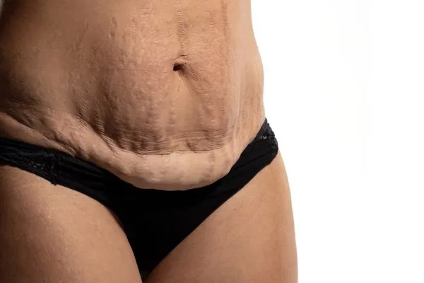 The Science of Skin Tightening 1 The science behind skin tightening Poole picture of a woman's sagging skin on the stomach
